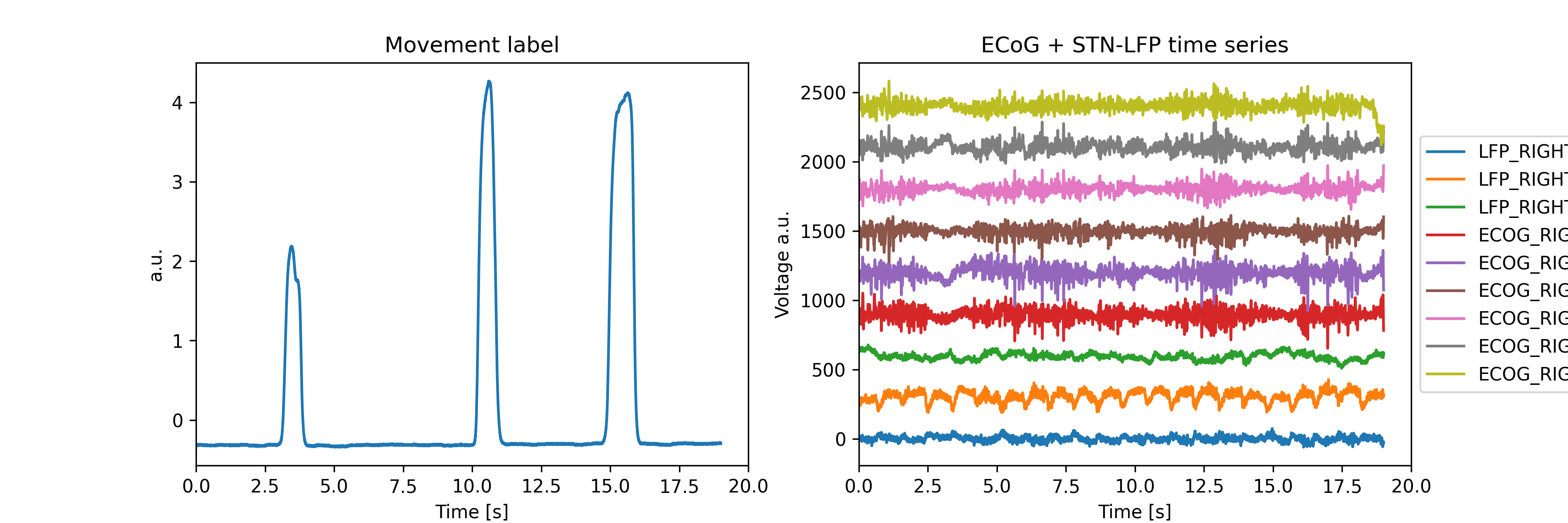 Movement label, ECoG + STN-LFP time series